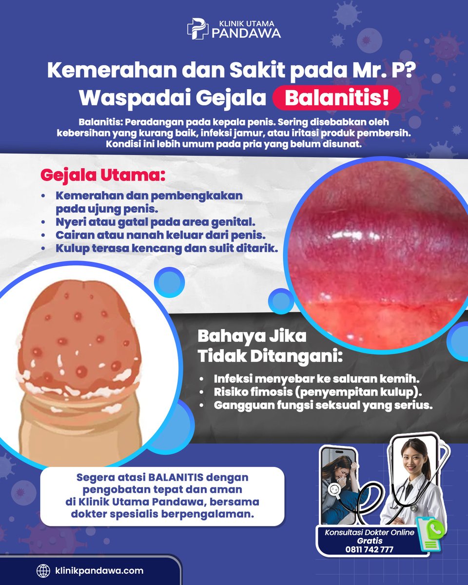klinik_pandawa's tweet photo. Balanitis: Peradangan pada kepala penis yang dapat menyebabkan kemerahan, gatal, dan rasa nyeri. Penyebabnya bisa karena kebersihan kurang baik, infeksi, atau iritasi. Segera periksakan ke dokter spesialis kami! Konsultasi GRATIS di 0811-742-777.
#Balanitis #KesehatanKelamin https://t.co/57xIWLbN11