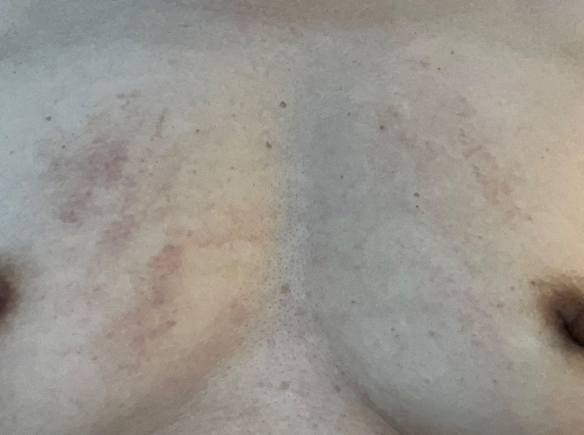 오랜만에 만진 가슴이라 떡 주무르듯 주물렀더니 꽤 오래갈 흔적이 완성됐네.
 
50넘은 중년의 가슴은 언제나 만족스럽다