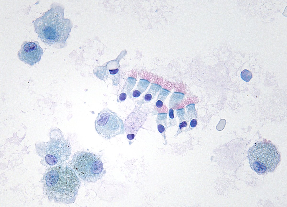 Finding morphologic beauty in a simple cytologic sample of lung lavage.
