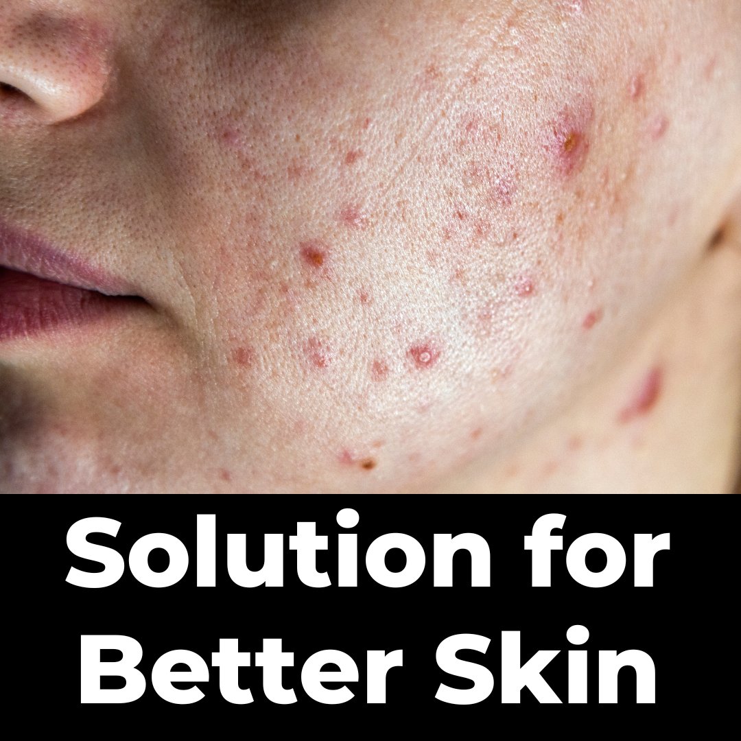 DrBPHealth's tweet photo. Skin health is very closely tied to gut &amp; liver health.

If you want to improve your skin, look at healing your gut, liver &amp; improve your body's detoxification.

THREAD https://t.co/PEVYBhhtf9