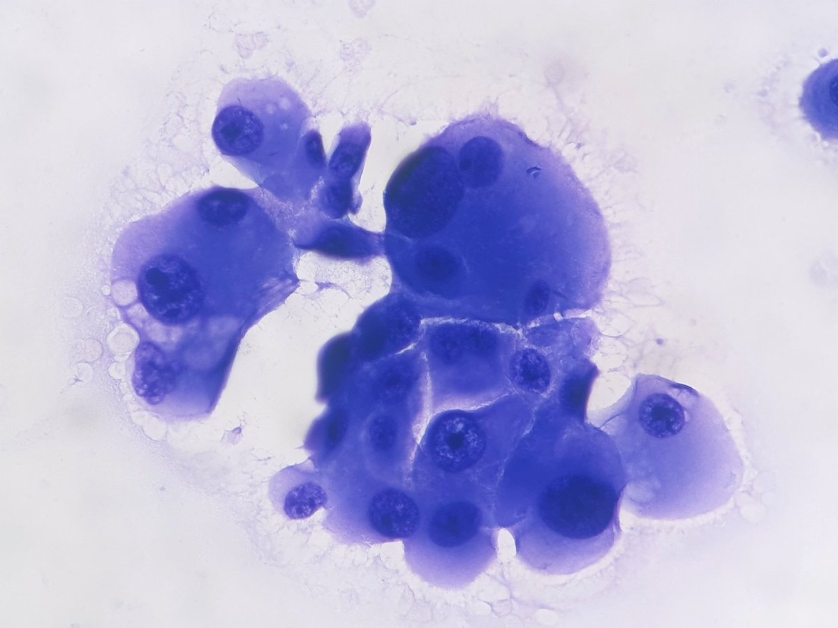 Lung mass. Cell block from pleural effusion 🍀 #cytopath #PathTwitter