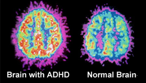 NickDiFabio1's tweet photo. Your ADHD brain isn't broken.

It's actually designed for success.

Some of the world's most successful people have ADHD.

The difference between you &amp; them?

They learned how to use it.

Here's what it REALLY is, how it works, (&amp; how to turn your ADHD into a superpower): https://t.co/ba0wFkRP0R