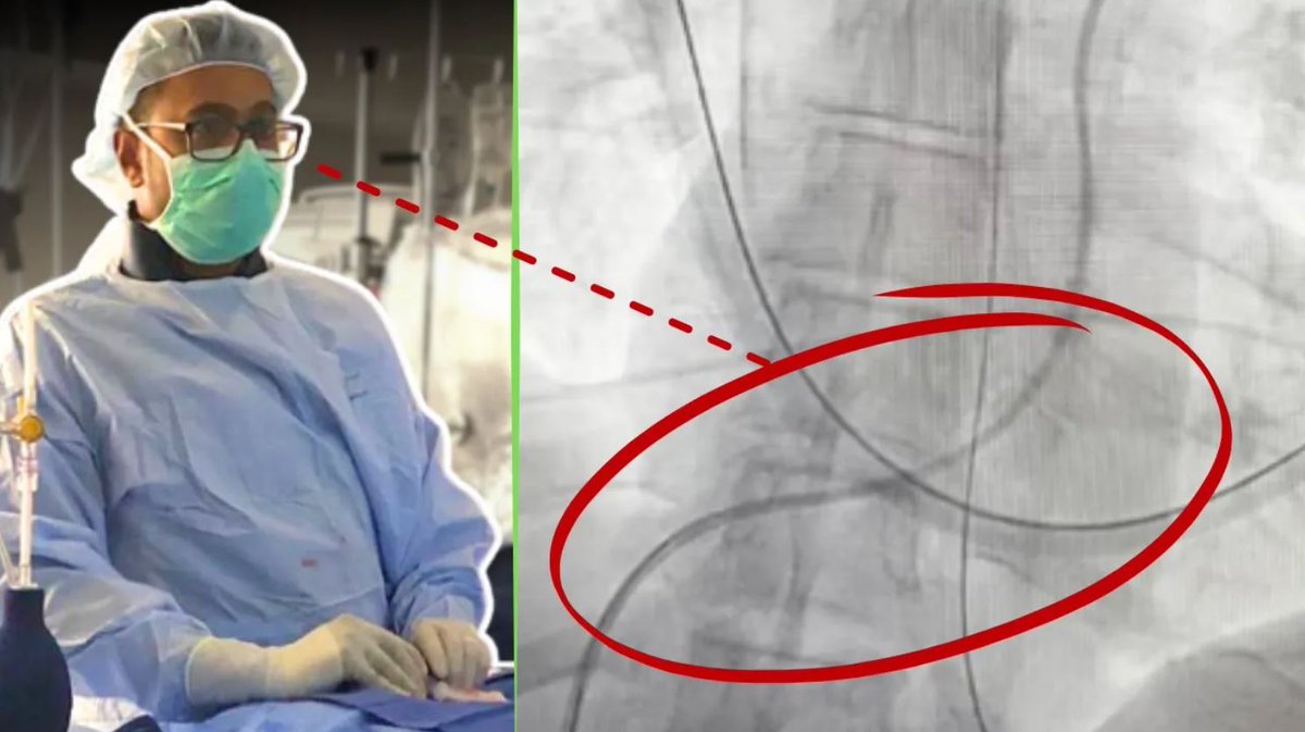 Join Dr. Jay Mohan for his expert analysis of a case of cardiogenic shock in a middle-aged patient with severe coronary artery disease.

Learn how quick interventions stabilized the patient and improved outcomes. ▶️👉 bit.ly/4a2ORaw