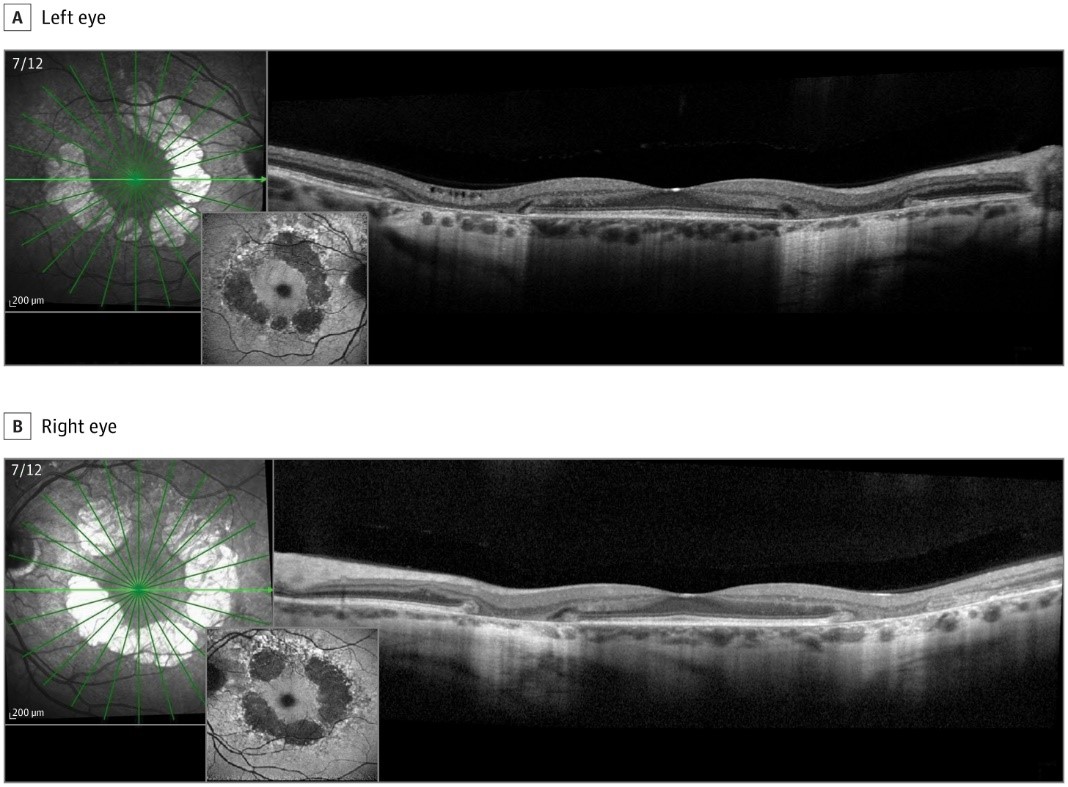 Mayo Clinic Department of Ophthalmology (@mayocliniceye) on Twitter photo With over 2,000 views to date: Reeda Bou Said, M.D. & <a href="/AndrewBarkmeier/">Andrew Barkmeier MD</a> present a case of bilateral perifoveal atrophy in a 46-year-old woman who was referred for a second opinion regarding hydroxychloroquine retinal toxicity in <a href="/JAMAOphth/">JAMA Ophthalmology</a>. bit.ly/4hsRcyp With over 2,000 views to date: Reeda Bou Said, M.D. & <a href="/AndrewBarkmeier/">Andrew Barkmeier MD</a> present a case of bilateral perifoveal atrophy in a 46-year-old woman who was referred for a second opinion regarding hydroxychloroquine retinal toxicity in <a href="/JAMAOphth/">JAMA Ophthalmology</a>. bit.ly/4hsRcyp