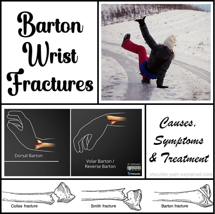 ShoulderPainExp's tweet photo. Barton Fractures of the wrist are usually caused by high impact activities or falls. Find out about the causes, symptoms and treatment options for this type of wrist fracture - https://t.co/p7uRA3pjij https://t.co/KG7vUYfnPl