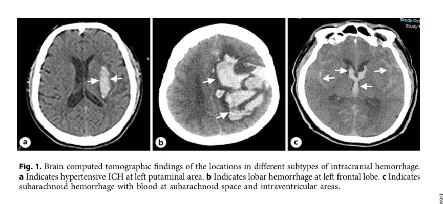 DrDeLaUCI's tweet photo. HEMORRAGIA INTRACRANEAL 

🔺EVC Hemorragico constituye el 27.9% de los casos de enfermedad vascular

🔺En la lesion inicial el hematoma provoca efecto de masa 

🔺La lesión secundaria activa la microglia que altera la permeabilidad de la barrera hematoencefalica https://t.co/eOwwxYBg6v