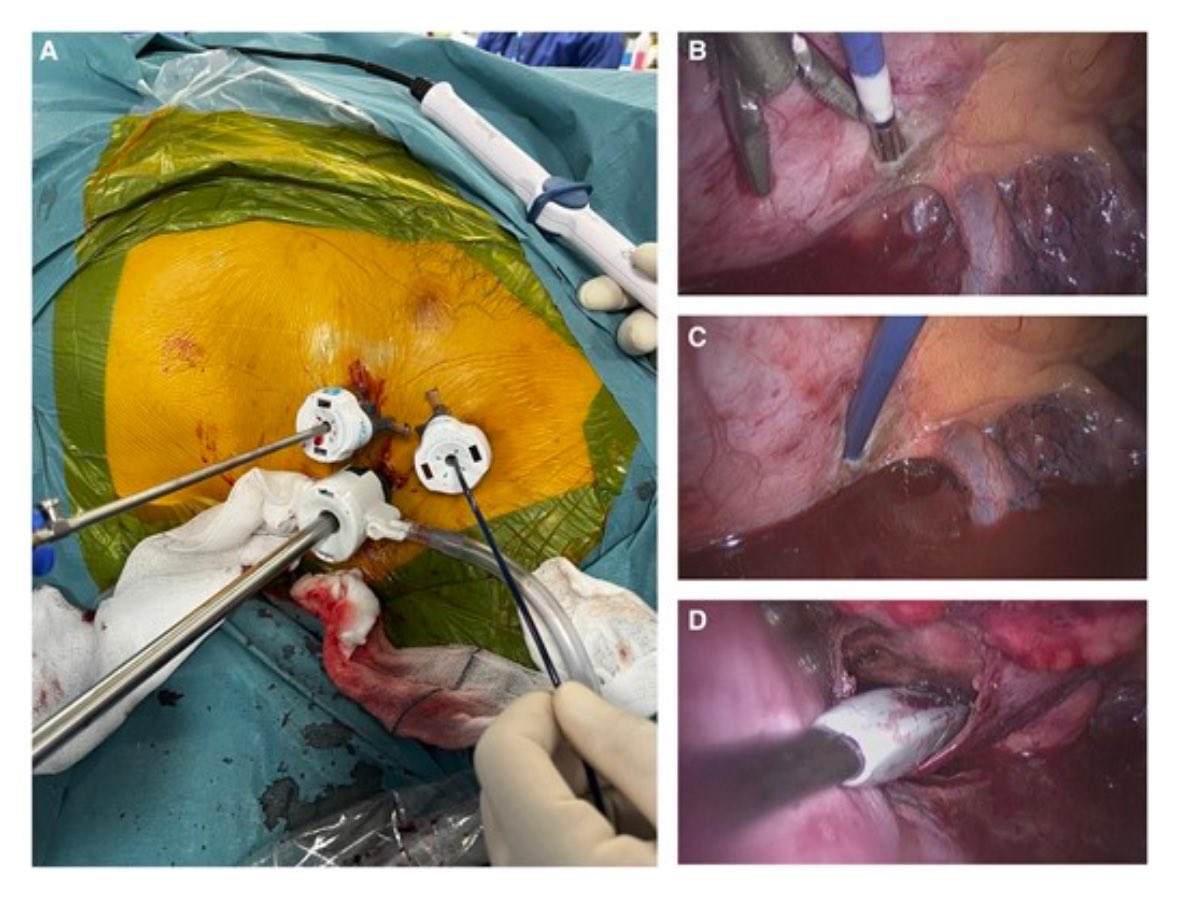 Mark Mills (@drmarkmills) on Twitter photo #EPeeps - see our case report on epicardial VT ablation using a surgical ablation device via video-assisted thoracoscopic surgery with electroanatomical mapping integration
Link: academic.oup.com/ehjcr/article/…
<a href="/GraemeKCrm/">Graeme Kirkwood</a> <a href="/SheffieldHosp/">Sheffield Hospitals</a> #ablateVT #EPeeps - see our case report on epicardial VT ablation using a surgical ablation device via video-assisted thoracoscopic surgery with electroanatomical mapping integration
Link: academic.oup.com/ehjcr/article/…
<a href="/GraemeKCrm/">Graeme Kirkwood</a> <a href="/SheffieldHosp/">Sheffield Hospitals</a> #ablateVT