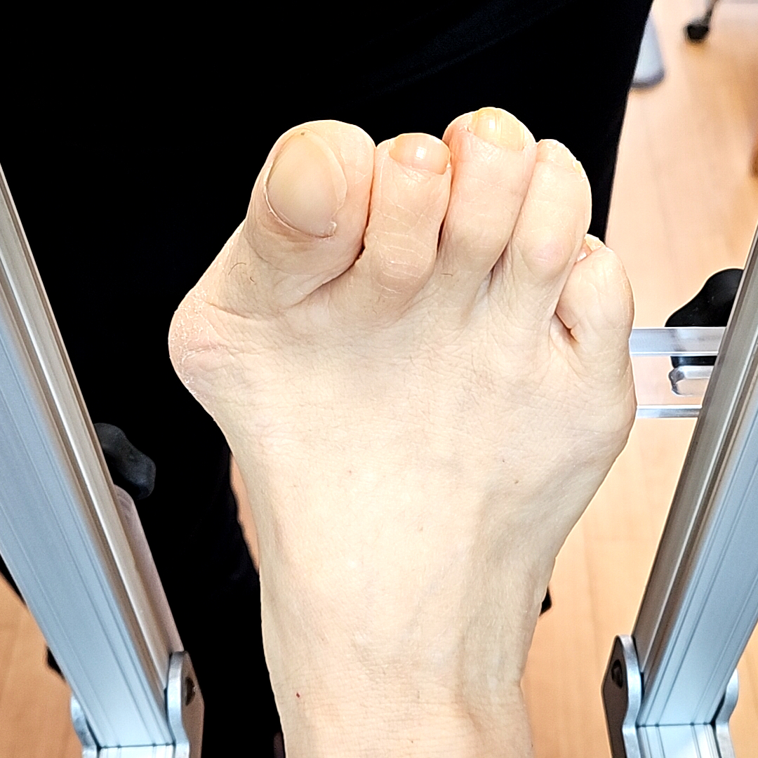FOOTLAB_INSOLE's tweet image. 外反母趾の間違った対応を見直しましょう
◎ 親指を引っ張るようなテーピングやサポーター
◎ 足の指に挟むような外反母趾グッズ
◎ アーチが高いインソール
◎ ホーマン体操
◎ タオルギャザー
◎ 5本指ソックス
このような対応はおすすめしません
wix.to/3vErXTM
#外反母趾 #NWPL