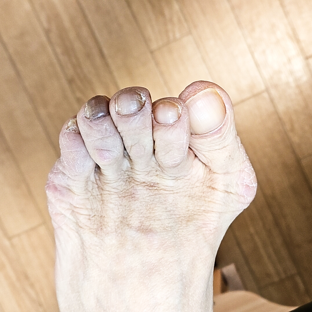 FOOTLAB_INSOLE's tweet image. 外反母趾の間違った対応を見直しましょう
◎ 親指を引っ張るようなテーピングやサポーター
◎ 足の指に挟むような外反母趾グッズ
◎ アーチが高いインソール
◎ ホーマン体操
◎ タオルギャザー
◎ 5本指ソックス
このような対応はおすすめしません
wix.to/3vErXTM
#外反母趾 #NWPL