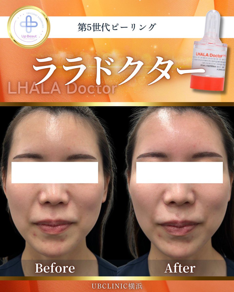 ララドクター症例】 ララピールの進化版、「ララドクター」は抗炎症