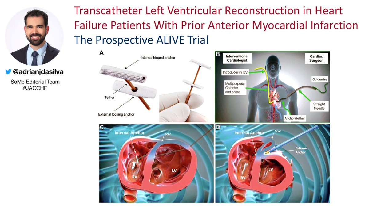 adrianjdasilva's tweet image. New in JACC HF: Results of the ALIVE Trial using the Revivient TC system for #LV dimension reduction.
shorturl.at/sjwgL