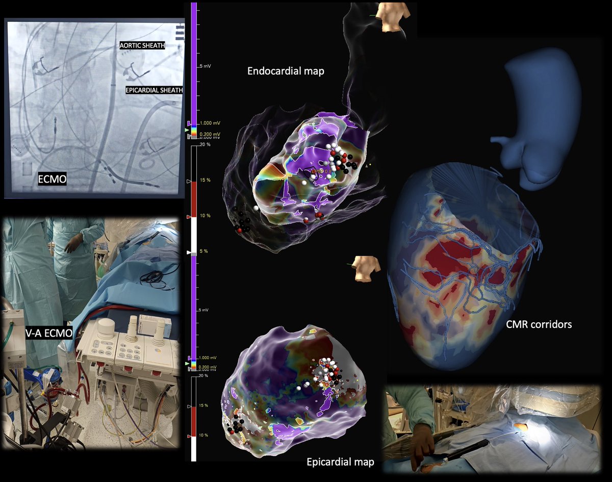 Michail Efremidis (@mefraimidis) on Twitter photo Epi and endo VT ablation for the management of an electrical storm.The procedure was supported by AV ECMO. A CMR-aided VT ablation was utilized @SteliosDragasis@athsaplaouras@ipetemil<a href="/K_Letsas/">Konstantinos Letsas</a><a href="/Kariki_O/">Ourania Kariki</a> <a href="/BellosPeriklis/">Periklis Bellos</a><a href="/eva_nyktari/">Eva Nyktari</a> #Onassis Hospital Epi and endo VT ablation for the management of an electrical storm.The procedure was supported by AV ECMO. A CMR-aided VT ablation was utilized @SteliosDragasis@athsaplaouras@ipetemil<a href="/K_Letsas/">Konstantinos Letsas</a><a href="/Kariki_O/">Ourania Kariki</a> <a href="/BellosPeriklis/">Periklis Bellos</a><a href="/eva_nyktari/">Eva Nyktari</a> #Onassis Hospital