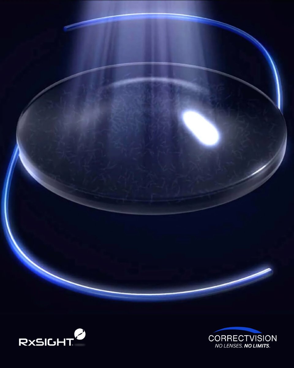 correctvision's tweet image. 👁️ Experience personalized vision like never before with the RxSIGHT Light Adjustable Lens at CorrectVision! 🌟 Customize your vision after surgery for unmatched clarity and focus.

📞 Call (954) 442-1133 to learn more!

#CorrectVision #RxSIGHT #CustomVision #CataractSurgery