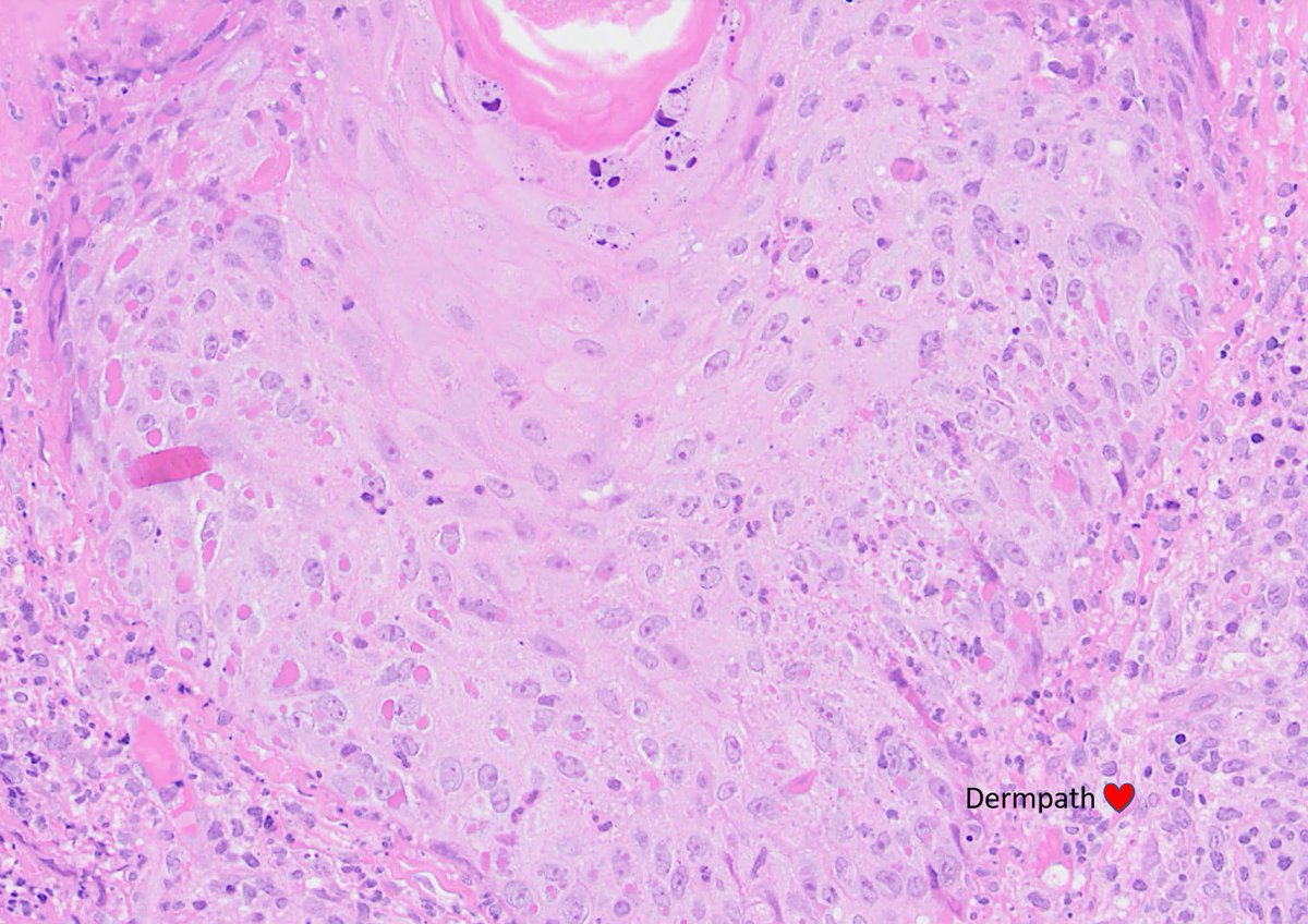 DermpathLove's tweet photo. Ulcerated lesions face. A colleague's case. #dermpath https://t.co/gnrXLG1rbG
