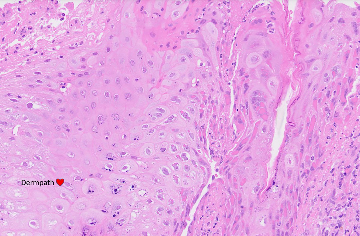 Ulcerated lesions face. A colleague's case. #dermpath