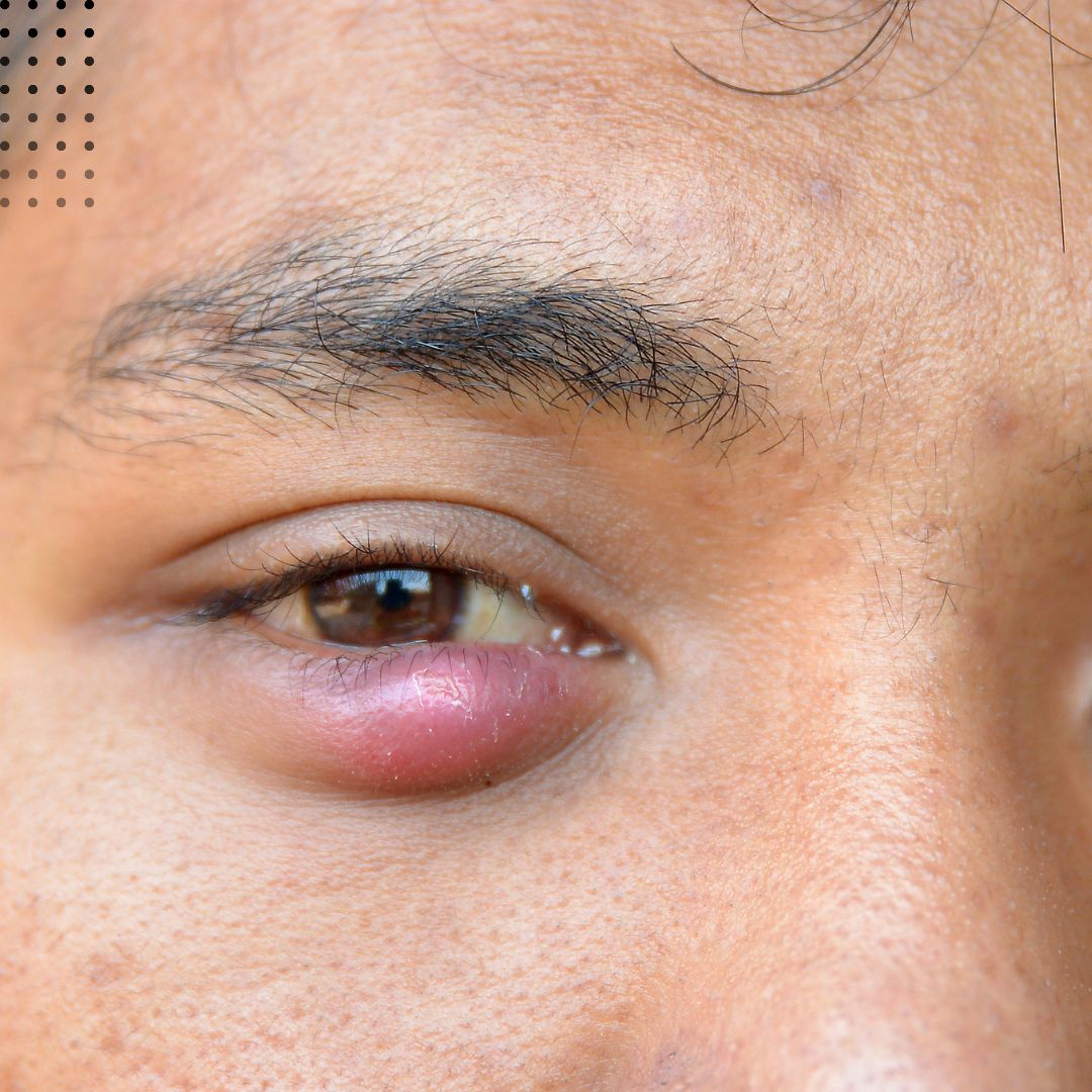 👀 Dealing with a stye? Home remedies can work wonders! Try applying a warm, damp cloth on the affected eye for 10 to 15 minutes, a few times a day. This simple method can help speed up the healing process. If you don’t see improvement after a few days, don’t hesitate to sched...