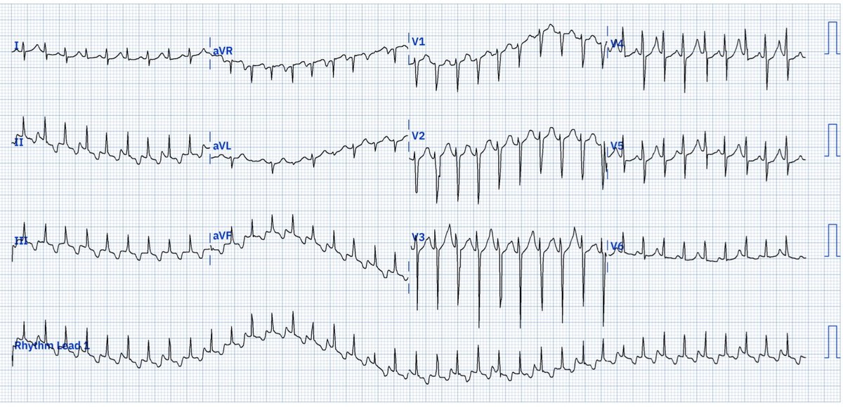 José Luis Morales (@jl_moralesart) on Twitter photo 28 YO Female comes to the ER with palpitations
Tachy Solved by Adenosine 6mg
Rythm?
<a href="/LopezLizarraga_/">Miguel Angel Lopez-Lizarraga</a> <a href="/marioalrb84_a/">Dr. tocino</a> <a href="/ecgrhythms/">Arnel Carmona</a> <a href="/adribaran/">Adrian Baranchuk MD FACC FRCPC FCCS FSIAC</a> <a href="/Alexisvvmijares/">Alexis Hartmann</a> <a href="/EkgHacks/">ECG.Hacks</a> <a href="/DidlakeDW/">David Didlake</a> <a href="/syamkumarmd/">Syamkumar</a> <a href="/12_Derivaciones/">12 Derivaciones ECG</a> <a href="/UlhasDr/">Dr Ulhas Pandurangi</a> <a href="/ecgandrhythmRoe/">Dr. Andreas Roeschl</a> <a href="/EPeeps_Bot/">EP_Bot</a>
#EP #EPEEPS #ECG #EKG #Cardiology 28 YO Female comes to the ER with palpitations
Tachy Solved by Adenosine 6mg
Rythm?
<a href="/LopezLizarraga_/">Miguel Angel Lopez-Lizarraga</a> <a href="/marioalrb84_a/">Dr. tocino</a> <a href="/ecgrhythms/">Arnel Carmona</a> <a href="/adribaran/">Adrian Baranchuk MD FACC FRCPC FCCS FSIAC</a> <a href="/Alexisvvmijares/">Alexis Hartmann</a> <a href="/EkgHacks/">ECG.Hacks</a> <a href="/DidlakeDW/">David Didlake</a> <a href="/syamkumarmd/">Syamkumar</a> <a href="/12_Derivaciones/">12 Derivaciones ECG</a> <a href="/UlhasDr/">Dr Ulhas Pandurangi</a> <a href="/ecgandrhythmRoe/">Dr. Andreas Roeschl</a> <a href="/EPeeps_Bot/">EP_Bot</a>
#EP #EPEEPS #ECG #EKG #Cardiology