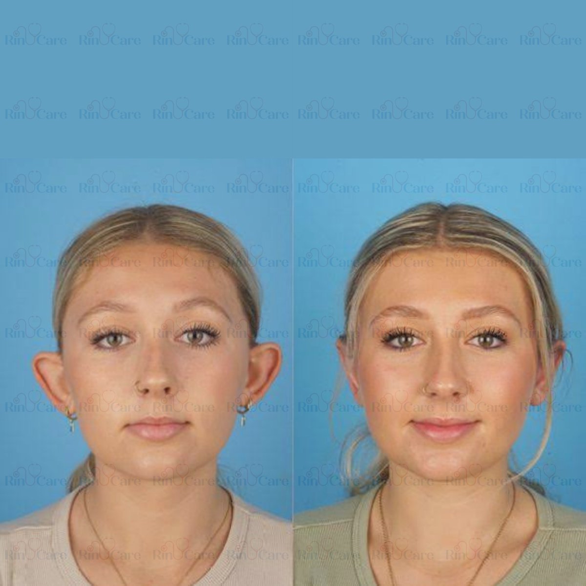 rinucare's tweet photo. #EarSurgery #Otoplasty #EarCorrection #CosmeticEarSurgery #EarReshaping #PerfectEars #EarTransformation #PlasticSurgery #FacialAesthetics #OtoplastyResults #EarSurgeryTurkey #OtoplastyTurkey #CosmeticSurgeryTurkey #EarSurgeryIstanbul #TurkeyPlasticSurgery #MedicalTourismTurkey https://t.co/tLO8J014OR