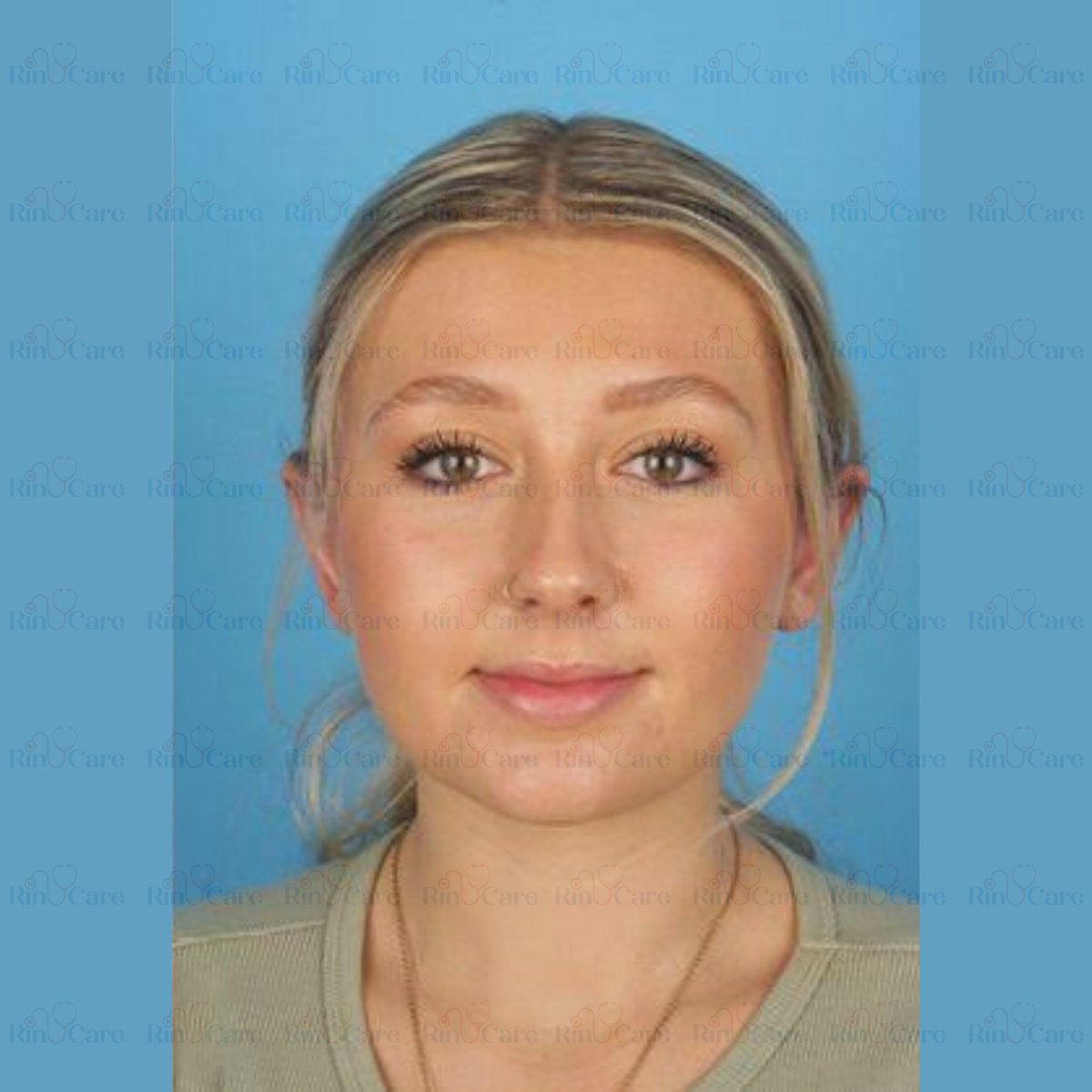 rinucare's tweet photo. #EarSurgery #Otoplasty #EarCorrection #CosmeticEarSurgery #EarReshaping #PerfectEars #EarTransformation #PlasticSurgery #FacialAesthetics #OtoplastyResults #EarSurgeryTurkey #OtoplastyTurkey #CosmeticSurgeryTurkey #EarSurgeryIstanbul #TurkeyPlasticSurgery #MedicalTourismTurkey https://t.co/tLO8J014OR