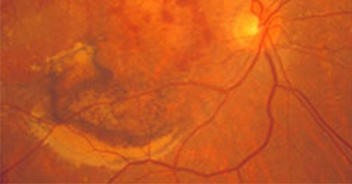 aao_ophth's tweet image. Register now for #Retina CME Webinar on 2/27. Join retina experts and #ASRS to learn about 2025 updates on wet #AMD, dry geographic atrophy, #pseudophakic CME, and surgical management. Free for Academy members. ow.ly/AmU450UMX3j