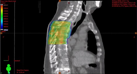 13/20 #TumorBoardTuesday

📋Back to our case

65M with de novo low-volume mCSPC

Prostate RT 5500 cGy ⚡ in 20 fractions
SBRT 2000 cGy ⚡X5 fractions to T7 and L3 mets
SBRT 4000 cGy ⚡ X5 fractions to L iliac met