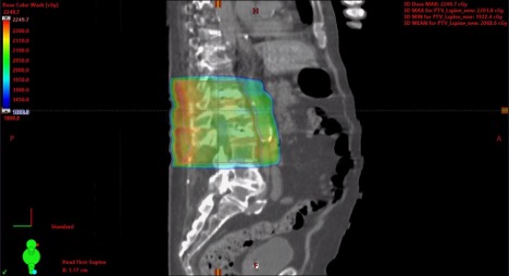 DrGallent's tweet photo. 13/20 #TumorBoardTuesday

📋Back to our case

65M with de novo low-volume mCSPC

Prostate RT 5500 cGy ⚡ in 20 fractions
SBRT 2000 cGy ⚡X5 fractions to T7 and L3 mets
SBRT 4000 cGy ⚡ X5 fractions to L iliac met