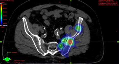 DrGallent's tweet photo. 13/20 #TumorBoardTuesday

📋Back to our case

65M with de novo low-volume mCSPC

Prostate RT 5500 cGy ⚡ in 20 fractions
SBRT 2000 cGy ⚡X5 fractions to T7 and L3 mets
SBRT 4000 cGy ⚡ X5 fractions to L iliac met