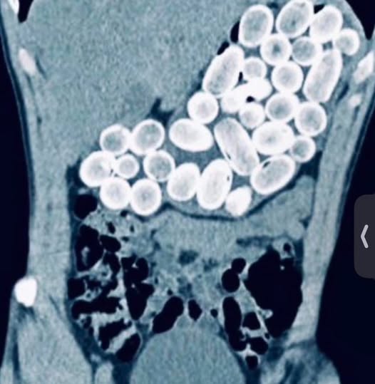 MedInsightMD's tweet photo. Patient presented from the airport with abdominal pain. X-ray, the abdominal test. What is your diagnosis? https://t.co/v7TC6gvFhg