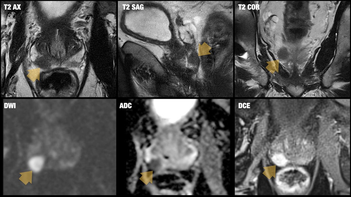 Daniel Souza (@danatsouza) on Twitter photo 61-year-old male patient presenting with elevated PSA and 1.6 cm focal lesion in the right PZ. PI-RADS score? Next step? <a href="/lkayat/">Leonardo Kayat Bit..</a> <a href="/Purysko/">Andrei Purysko</a> <a href="/BrighamRad/">Brigham and Women's Radiology</a> <a href="/FOAMrad/">FOAMrad</a> <a href="/SAR_RFS/">SAR Resident and Fellow Section</a> <a href="/futureradres/">Future Radiology Residents</a> <a href="/CBRadiologia/">CBR</a> #MedEd 61-year-old male patient presenting with elevated PSA and 1.6 cm focal lesion in the right PZ. PI-RADS score? Next step? <a href="/lkayat/">Leonardo Kayat Bit..</a> <a href="/Purysko/">Andrei Purysko</a> <a href="/BrighamRad/">Brigham and Women's Radiology</a> <a href="/FOAMrad/">FOAMrad</a> <a href="/SAR_RFS/">SAR Resident and Fellow Section</a> <a href="/futureradres/">Future Radiology Residents</a> <a href="/CBRadiologia/">CBR</a> #MedEd