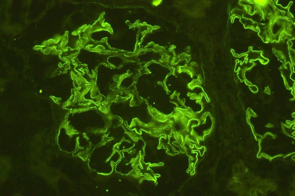 RenalPathLabs's tweet photo. Young female- Victim of Ayurvedic fairness cream induced MGN.
Don’t run after fair colour, beauty is skin deep..Be Confident in your skin!
#SayNotoFairnessCreams #PathTwitter #NephTwitter #AskRenal #AwarenessPost #SecondaryMGN #Nell1 #KidneyBiopsy #FairnessCreaminducedMGN https://t.co/WUcFkejIgw