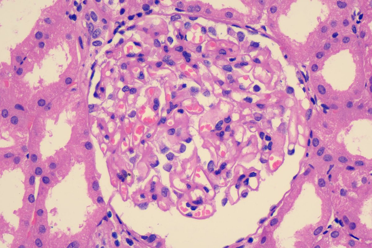 RenalPathLabs's tweet photo. Young female- Victim of Ayurvedic fairness cream induced MGN.
Don’t run after fair colour, beauty is skin deep..Be Confident in your skin!
#SayNotoFairnessCreams #PathTwitter #NephTwitter #AskRenal #AwarenessPost #SecondaryMGN #Nell1 #KidneyBiopsy #FairnessCreaminducedMGN https://t.co/WUcFkejIgw
