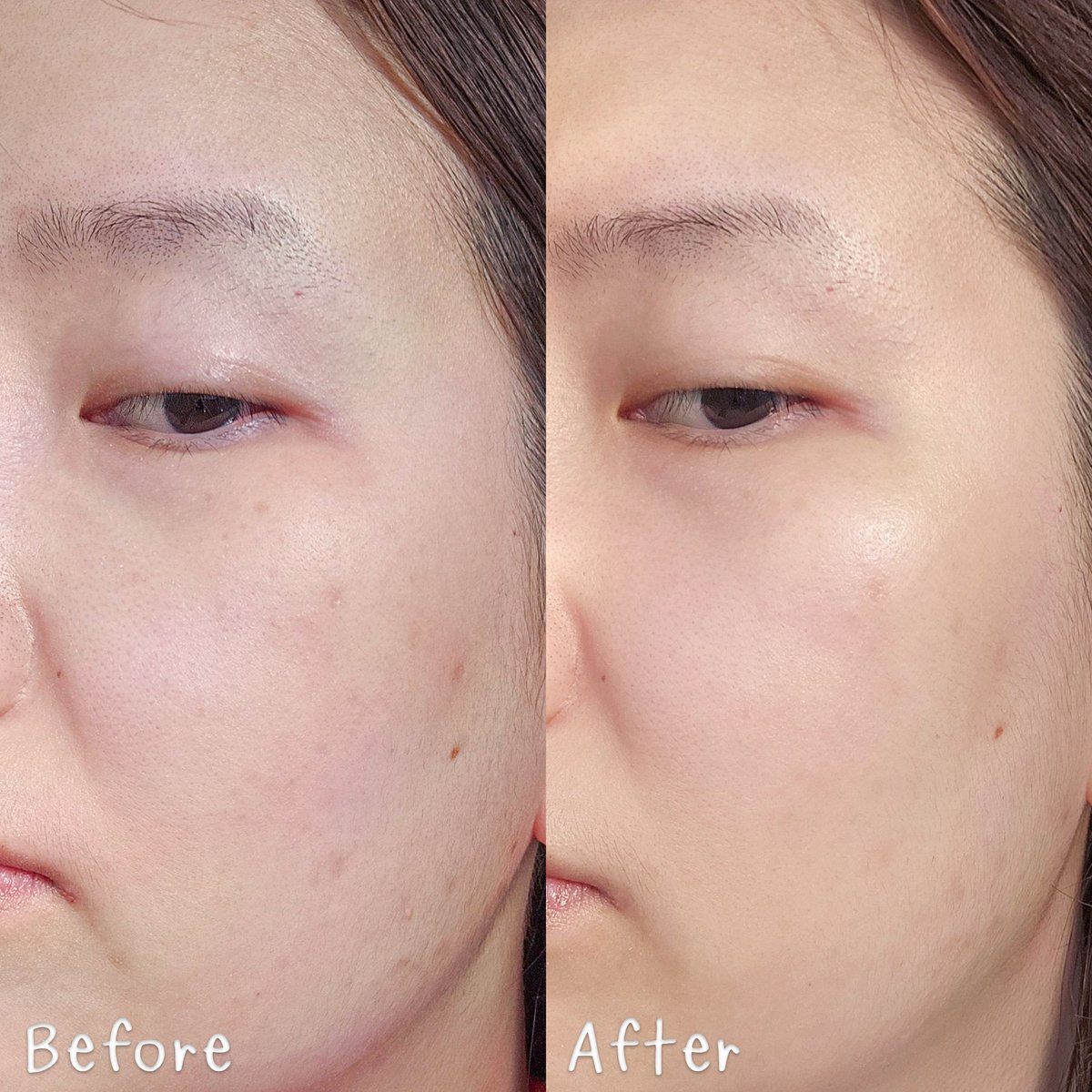 กลับมาซบ La Roche-Posay Efflaclar Serum  ทุกที ล่าสุดเป็นสิวซ้ำๆจุดเดิม เหมือนมันอุดตันใต้ผิวแล้วค่อยๆทยอยออกมา สิวอุดตันใต้ผิวจะเป็นต้นตอปัญหาสิวทั้งปวง สิวอักเสบเอย สิวผดเอย แล้วรอยสิวตามมาแน่ๆ Efflaclar สลายสิวอุดตันแบบเอาอยู่ สิวใหม่ไม่ปะทุ โดยรวมผิวดูเรียบเนียนขึ้นด้วย

🩵https://t.co/3SNz8lCHMD   
🩵https://t.co/lTWdDyasFO 

#LaRochePosayTH #Effaclar #ลาโรชโพเซย์ #เอฟฟาคลาร์ #เอฟฟาคลาร์ดูโอพลัสเอ็ม #ลดสิว #รอยสิว #EffaclarDuo #ผิวมัน