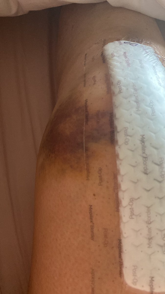 RedMags60's tweet photo. I felt like you’d want me to share. Five days post-op.
#IAmTitanium
😬 https://t.co/xSh6W9oMDP