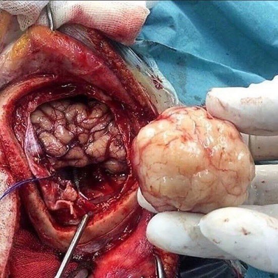 AbretuPotencial's tweet image. 5. Extirpación de un tumor cerebral.