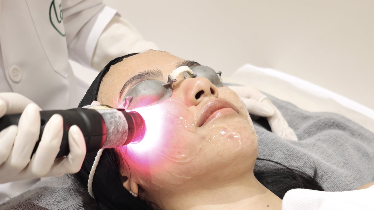 quenxHN's tweet image. หัตถการที่ยกให้เป็นที่สุดในปีที่ผ่านมา😭 The Loft Clinic เปลี่ยนชีวิตมาก

Red Touch Pro + V Beam คือเรามีรอยแดงเยอะมากๆจากเลเซอร์หัวสิว รอยอยู่นาน 2-3 เดือนเลย หลังทำคือ ค่อยๆดีขึ้นมากกกๆๆๆ ตอนนี้คือแทบไม่มีรอยเก่าๆแล้ว สิวขึ้นใหม่มีอยู่บ้างตามรอบเดือน…
