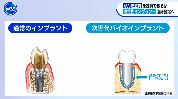 marketmaker7's tweet photo. これは画期的！
「次世代バイオインプラント」

歯根膜が機能するので噛む感覚があり、免疫機能も維持！まるで自分の歯のようになる！

ゲームチェンジャーになるインプラント！ https://t.co/TCGv6U58Yn