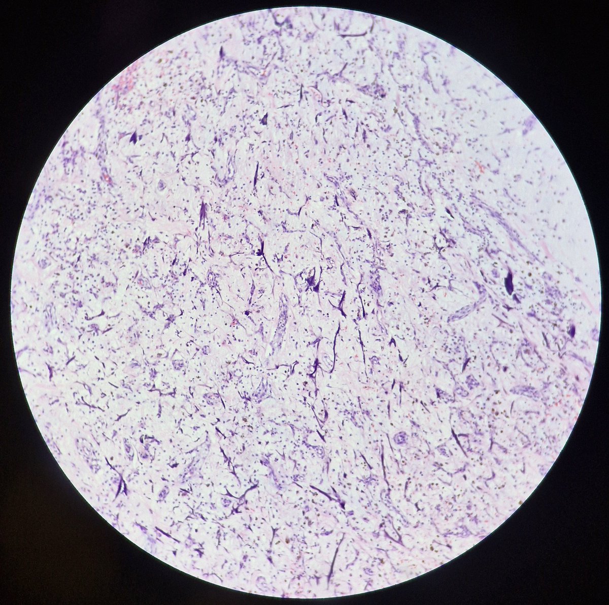 zivaledinek's tweet image. Can you❓️guess the diagnosis if I tell you that the dark purple fibers are called Gamna-Gandy bodies and represent degenerated collagen fibers encrusted with iron and calcium? ✏️ below #PathX #PathTrainee