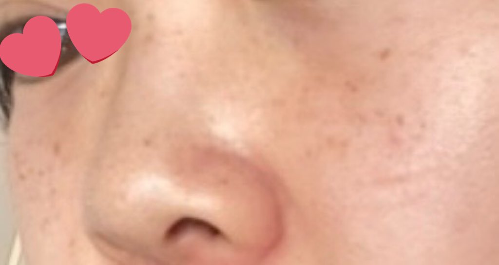 miipaipaii's tweet photo. 9ヶ月でそばかす結構減ったよ！
価格も安い〜高いの3プランくらい提案してくれて好きなの選べる🙆🏻
私は最初の3ヶ月だけは1番高い塗り薬有プランにして、今はずっとビタミンのお薬服用してるだけ〜 https://t.co/crxmfZyb5j