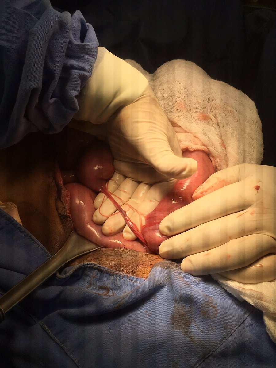 3 recordatorios de las adherencias:
1. Una brida no es lo mismo que una adherencia 
2. Nunca uses energía para la adherensiolisis
3. Solo enfócate en la adherencia que causa el problema, deja en paz a las demás 
#cirugía #cirujanos #crónicasquirúrgicas