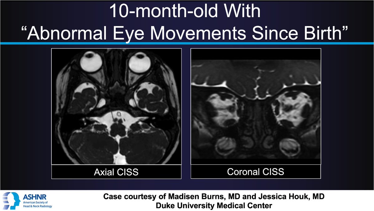 ASHNR (@ashnrsociety) on Twitter photo #ASHNRCOTW #283: Abnl eye movements. Thx
<a href="/madisenburns1/">madisen burns</a> + <a href="/jhoukMD/">Jessica Houk</a> 4 case! #ASHNR25
Answer w/ appropriate GIF only -- stay professional & don't spoil it!
<a href="/callyrobs/">Caroline Robson, MBChB</a> <a href="/DShatzkes/">Deborah Shatzkes</a> <a href="/CDP_Rad/">C Douglas Phillips 🇺🇸</a> <a href="/rhwiggins/">Richard Wiggins</a>
@nakoont <a href="/KRileyMD/">Kalen Riley</a> <a href="/CMGlastonbury/">Christine M Glastonbury, MD</a>
<a href="/tabby_kennedy/">Tabby A. Kennedy, MD</a> <a href="/PhilipRChapman1/">Philip R. Chapman, MD</a> #ASHNRCOTW #283: Abnl eye movements. Thx
<a href="/madisenburns1/">madisen burns</a> + <a href="/jhoukMD/">Jessica Houk</a> 4 case! #ASHNR25
Answer w/ appropriate GIF only -- stay professional & don't spoil it!
<a href="/callyrobs/">Caroline Robson, MBChB</a> <a href="/DShatzkes/">Deborah Shatzkes</a> <a href="/CDP_Rad/">C Douglas Phillips 🇺🇸</a> <a href="/rhwiggins/">Richard Wiggins</a>
@nakoont <a href="/KRileyMD/">Kalen Riley</a> <a href="/CMGlastonbury/">Christine M Glastonbury, MD</a>
<a href="/tabby_kennedy/">Tabby A. Kennedy, MD</a> <a href="/PhilipRChapman1/">Philip R. Chapman, MD</a>