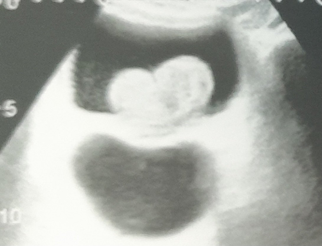 benatta mahmoud (@benatta2010) on Twitter photo Not as friendly or as it looks
Neither for the retentionist patient nor for the surgeon who performed #holep . Not as friendly or as it looks
Neither for the retentionist patient nor for the surgeon who performed #holep .