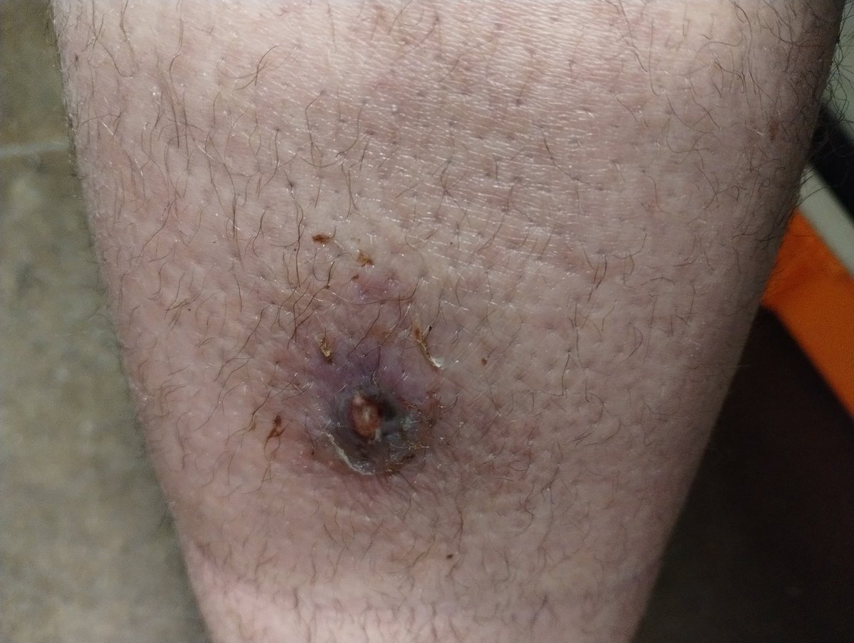 2AnonymousGhost's tweet photo. I KNOW I HAVEN'T POSTED ABOUT THE BITE IN AT LEAST 24HRS-36HRS THE FIRST 2 PICS YOU SEE ARE FROM THIS MORN'N 
THEN 3 WAS THE GAUZE THAT I JUST TOOK OFF CHANG'N THE BANDAGE HOW VERY LITTLE BLOOD WITH NO PUSS THEN HOW CLEAN AROUND THE AREA IT LOOKS IN PIC 4 I HAVE 2.5 DAYS OF https://t.co/75r7WIuBXe