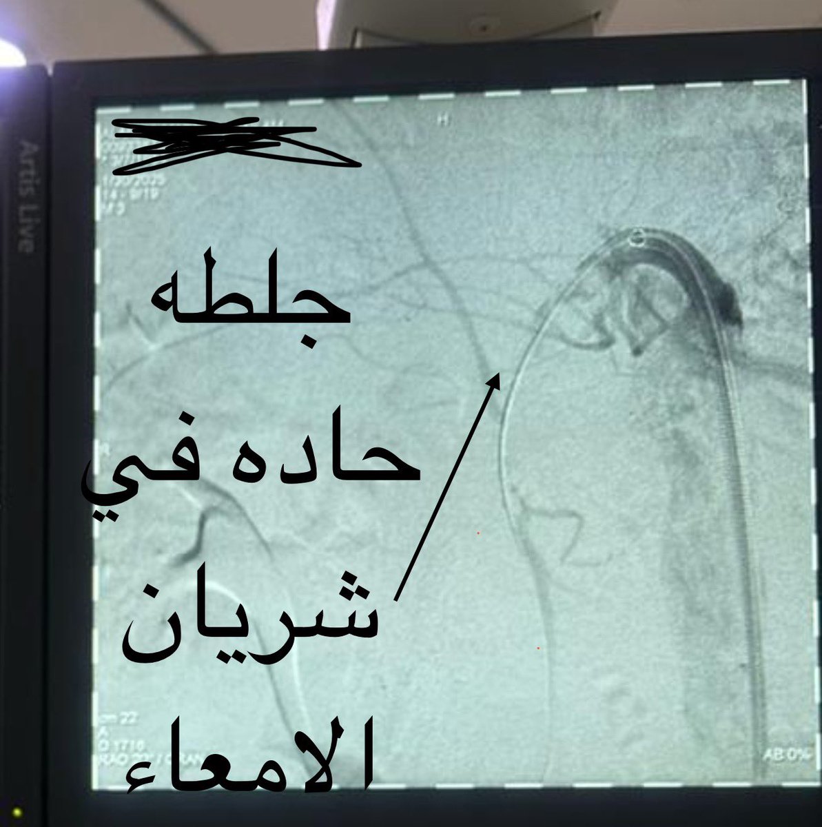 DrAlenazy's tweet image. حمدلله للتو  تم عمل اول حالة في مدينة الملك سعود الطبية 
لمريض في السبعينيات من عمره يشكي من الم حاد في البطن ،بعد عمل الاشعة المقطعيه تبين وجود جلطه حاده في شريان الامعاء الدقيقه ،
كلموني عليها اطباء الجراحه لامكانية ازالة الجلطه والحفاظ على الامعاء 
 تم الدخول عن طريق شريان…