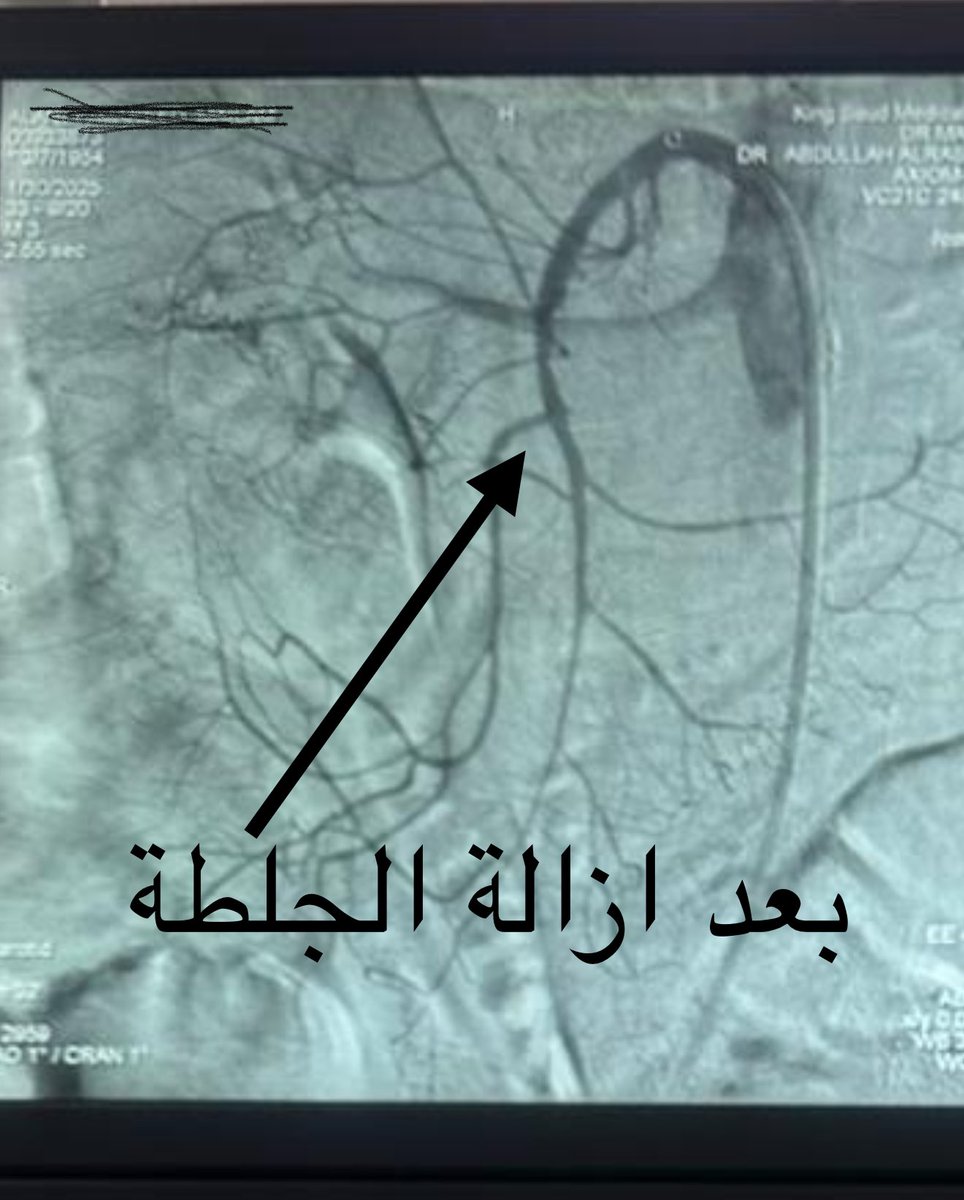 DrAlenazy's tweet image. حمدلله للتو  تم عمل اول حالة في مدينة الملك سعود الطبية 
لمريض في السبعينيات من عمره يشكي من الم حاد في البطن ،بعد عمل الاشعة المقطعيه تبين وجود جلطه حاده في شريان الامعاء الدقيقه ،
كلموني عليها اطباء الجراحه لامكانية ازالة الجلطه والحفاظ على الامعاء 
 تم الدخول عن طريق شريان…
