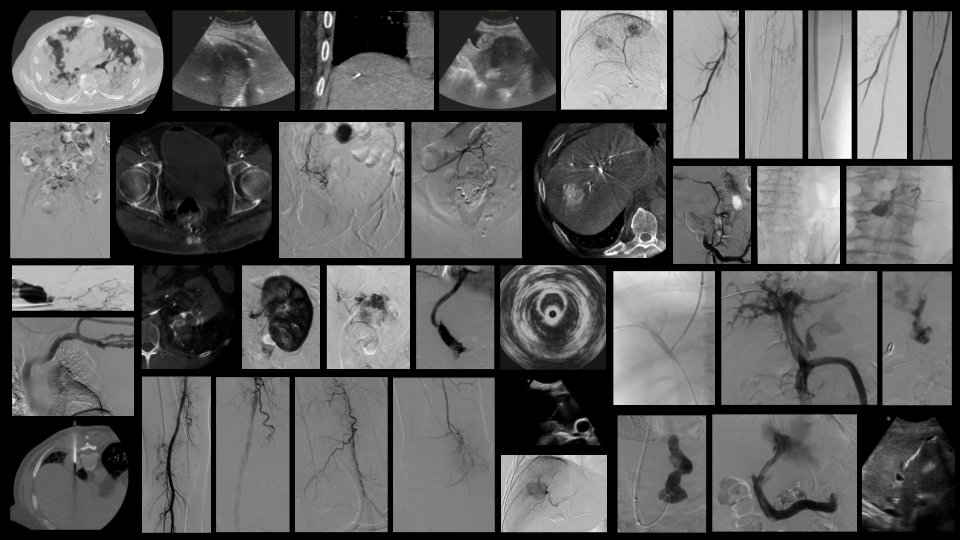 Kara Fitzgerald, MD (@kmfitzmd) on Twitter photo Back to the VA for Block 5 — hyperfocused on #PAD / #CLTI excellence with collaborative angio conference, clinic & inpatient PAD evaluation and follow up, PAT implementation… & all the other amazing #IRAD work as well! #limbsalvage #IRadRes <a href="/UofWa_IR/">University of Washington IR Residency</a> #1percentbettereveryday Back to the VA for Block 5 — hyperfocused on #PAD / #CLTI excellence with collaborative angio conference, clinic & inpatient PAD evaluation and follow up, PAT implementation… & all the other amazing #IRAD work as well! #limbsalvage #IRadRes <a href="/UofWa_IR/">University of Washington IR Residency</a> #1percentbettereveryday