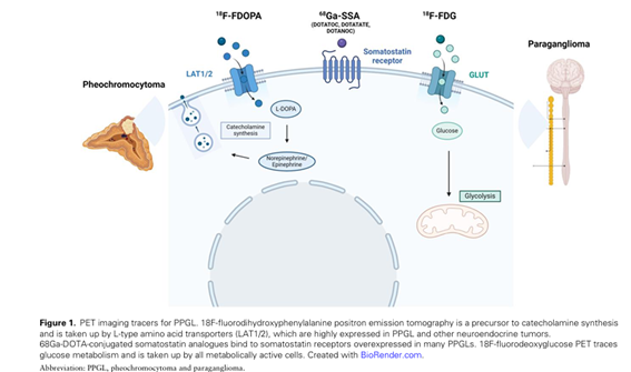 sociedadSEEN's tweet photo. 🟨Positron Emission Tomography Imaging of Pheochromocytoma and Paraganglioma—18F-FDOPA vs Somatostatin Analogues

👉El 18F-FDOPA es el más sensible para detectar feocromocitoma

https://t.co/PnKUL4SCAD
@NeuroendocrinoS https://t.co/SgWlPP0cHr