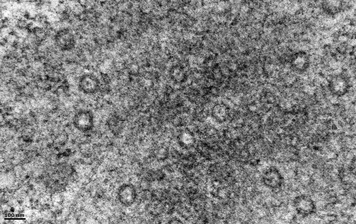 Kidney Bx. Looking for an infective agent by #electronmicroscopy.
Found these structures that can be misinterpreted as viruses. They are nuclear pores. The plane of section has tangentially traversed the edge of a nucleus.