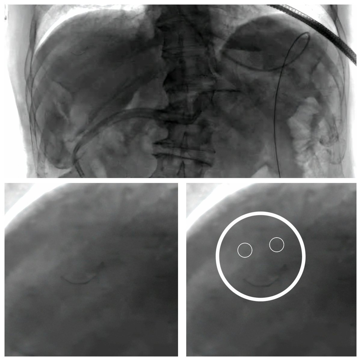 #lostandfoud ✈️🛩
miss the last needle at the end of your robotic whipple ✅️
spend 1 hour searching in the abdomen✅️
ask for help from x-ray ✅️
go home sleeping✅️
🦾🦾🦾