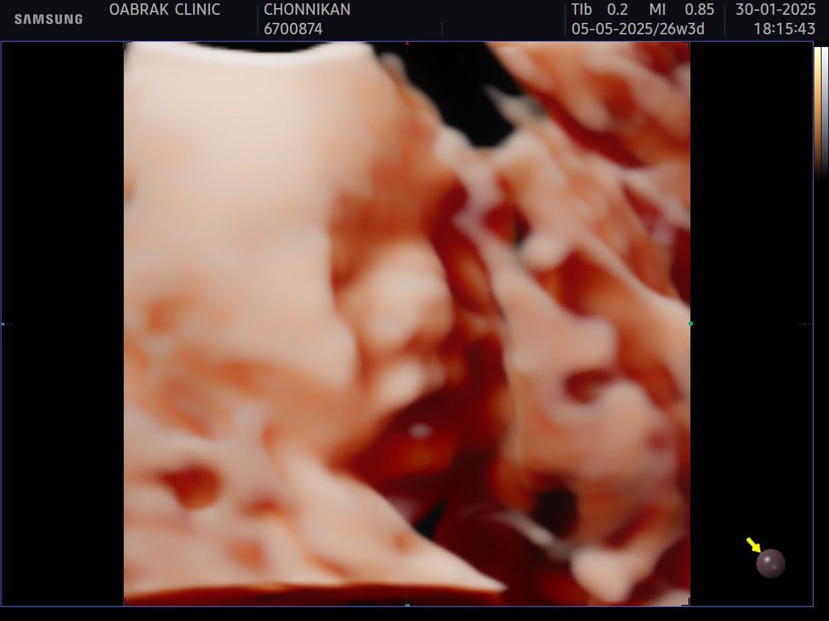 MChonnikan's tweet photo. ยูกฉาวววว 26weeks3days 927g 

💓💓💓💓 https://t.co/HF40HvCnUR