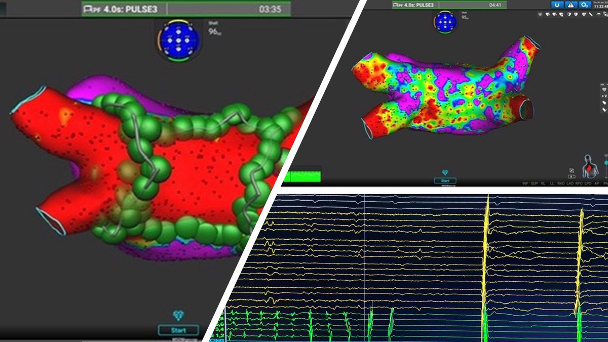 Panagiotis Mililis (@ipetemil) on Twitter photo PersAF pt converted into SR during PWI using #Medtronic AFFERA system.
<a href="/SteliosDragasis/">Stelios</a> <a href="/athsaplaouras/">Athanasios Saplaouras</a> <a href="/Kariki_O/">Ourania Kariki</a> <a href="/petros_skalidis/">Petros Skalidis</a> <a href="/K_Letsas/">Konstantinos Letsas</a> <a href="/MEfraimidis/">Michail Efremidis</a> #epeeps #OnassisCardiacSurgeryCentre PersAF pt converted into SR during PWI using #Medtronic AFFERA system.
<a href="/SteliosDragasis/">Stelios</a> <a href="/athsaplaouras/">Athanasios Saplaouras</a> <a href="/Kariki_O/">Ourania Kariki</a> <a href="/petros_skalidis/">Petros Skalidis</a> <a href="/K_Letsas/">Konstantinos Letsas</a> <a href="/MEfraimidis/">Michail Efremidis</a> #epeeps #OnassisCardiacSurgeryCentre